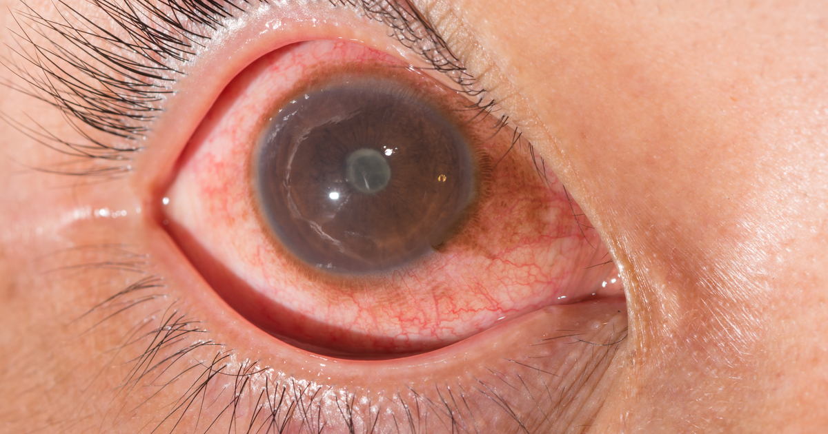 IBD Eye Problems Uveitis Crohn s Ulcerative Colitis