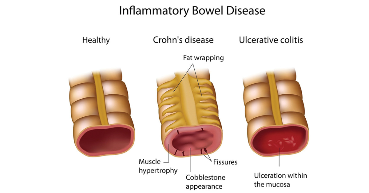 Worldwide Incidence And Prevalence Of Inflammatory Bowel Disease In The 