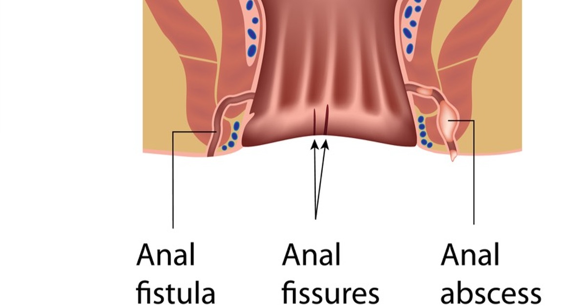 Anus fistula in painful repertory