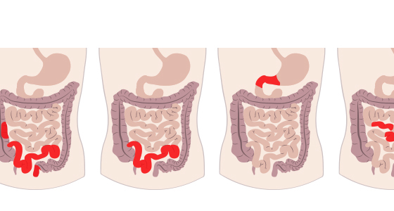 What is gastroduodenal Crohn's disease? | IBDrelief