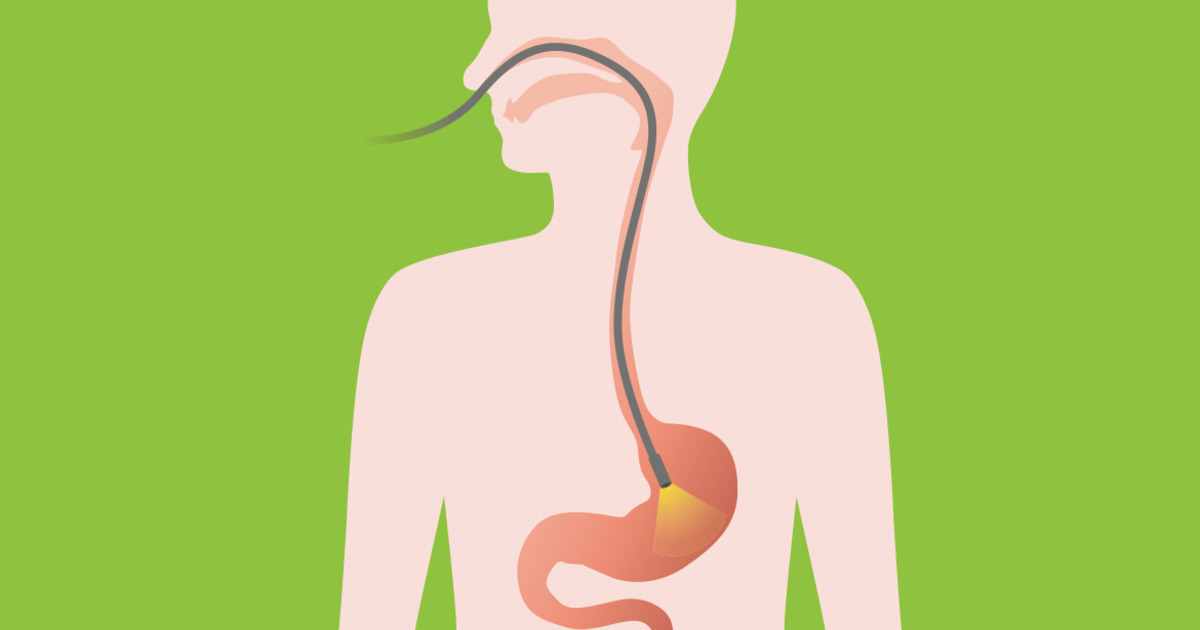 gastroscopy-how-a-gastroscopy-is-performed