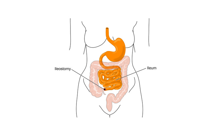 Ileostomy - inflammatory bowel disease (IBD) - Crohn's disease and ulcerative colitis (UC)