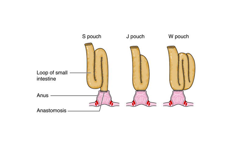 Restorative proctocolectomy with ileoanal pouch (or J-pouch)