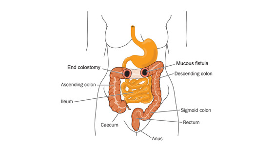 Surgery For Ibd Ibdrelief 3569