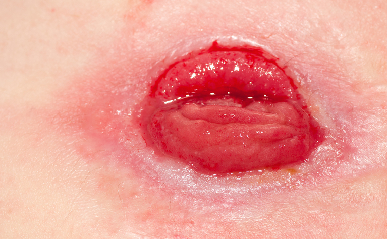 Ileostomy - inflammatory bowel disease (IBD) - Crohn's disease and ulcerative colitis (UC)