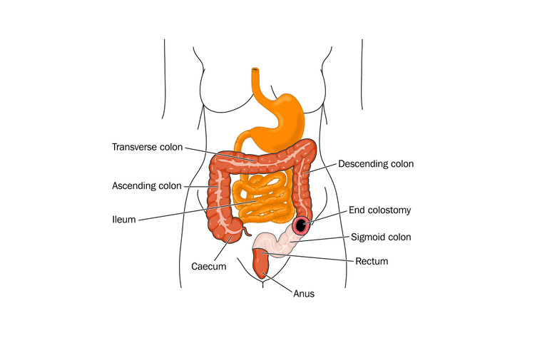 End colostomy for inflammatory bowel disease (IBD) - Crohn's disease and ulcerative colitis (UC)