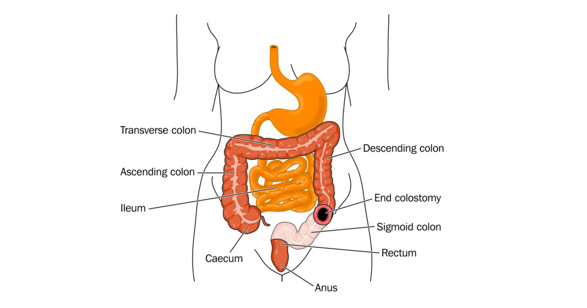 Colostomy How A Colostomy Is Performed