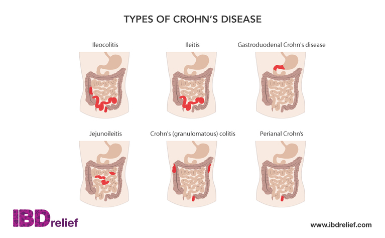 Crohn's disease | What is Crohn's disease? | IBDrelief