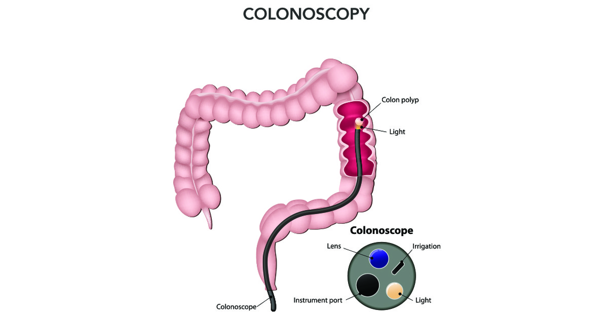 Colonoscopy And Inflammatory Bowel Disease IBDrelief