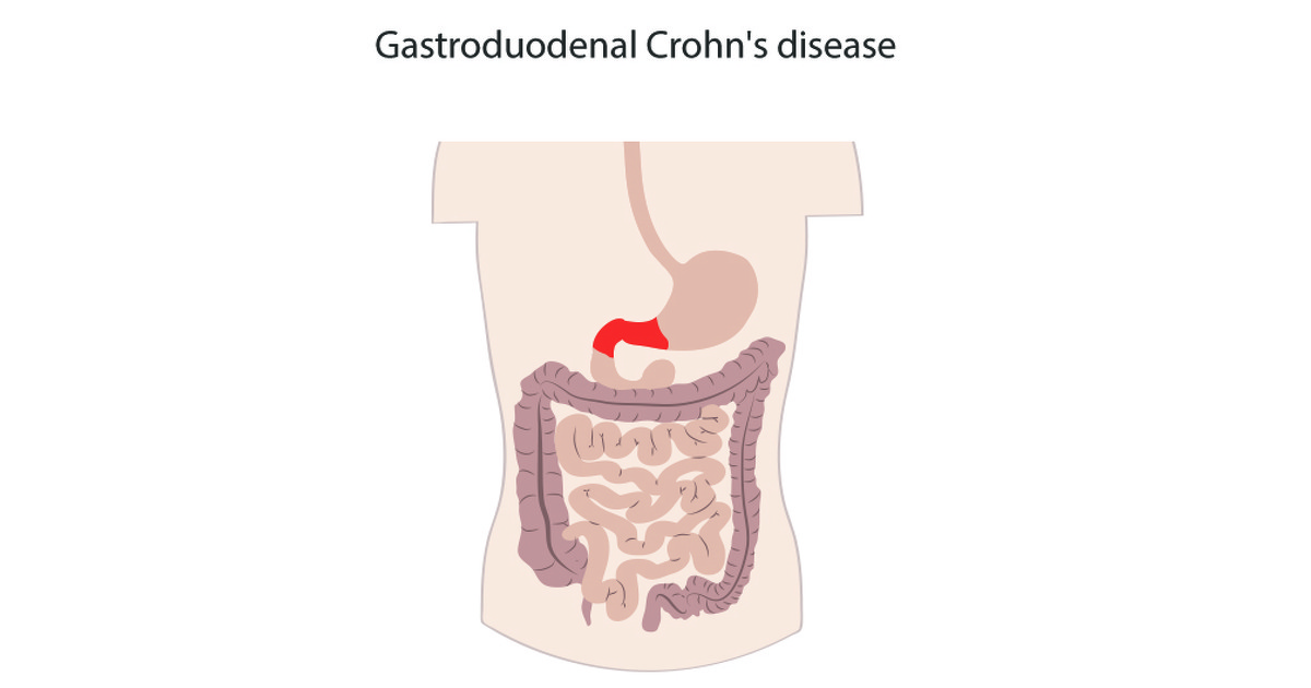 What is gastroduodenal Crohn's disease? | IBDrelief