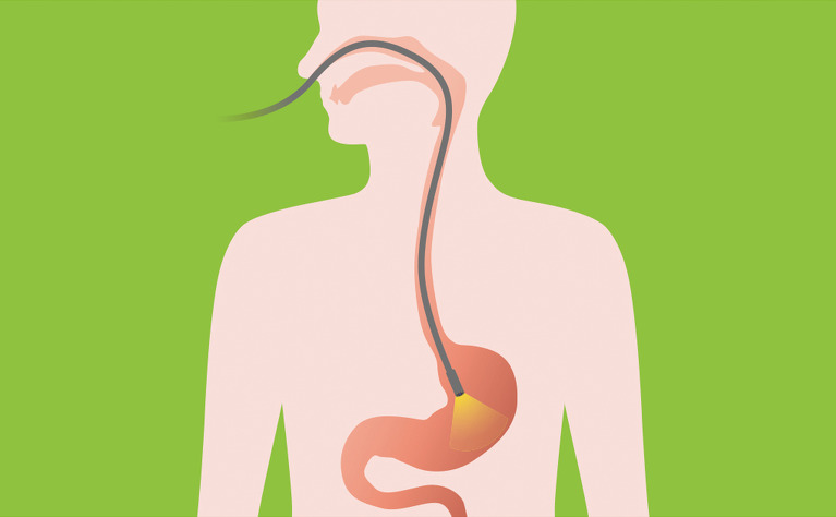 Picture of a gastroscopy going into a mouth to the stomach