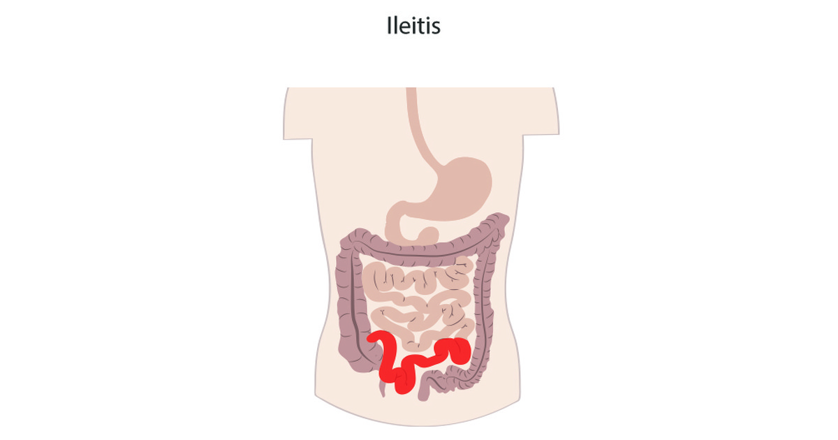 what-is-crohn-s-ileitis-crohn-s-disease-ibdrelief