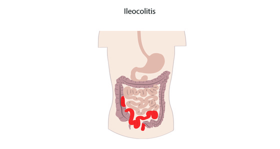What is perianal Crohn’s? | Crohn’s disease | IBDrelief