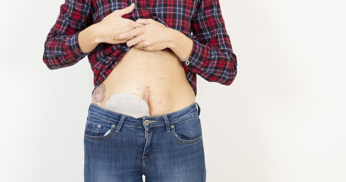 I'm living with an ileostomy – here's what I want people to know