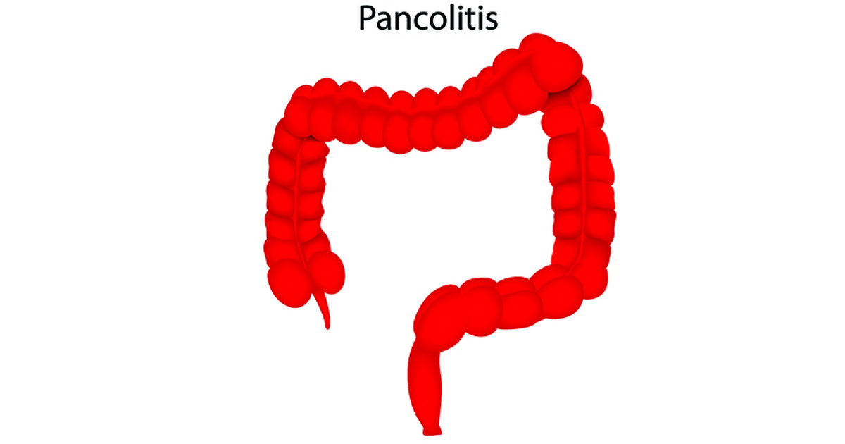 What is Pancolitis | Pancolitis | IBDrelief