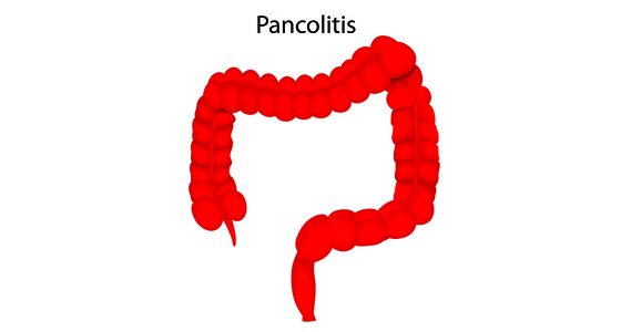 Left-sided (distal) colitis | IBDrelief