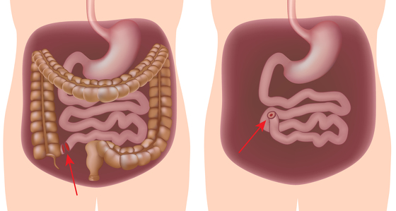 Pan-proctocolectomy with ileostomy surgery | IBDrelief