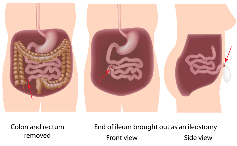 Proctocolectomy for inflammatory bowel disease (IBD) - Crohn's disease and ulcerative colitis