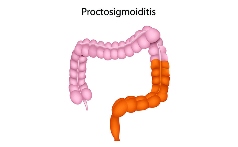 Proctosigmoiditis? | Ulcerative Colitis | IBDrelief