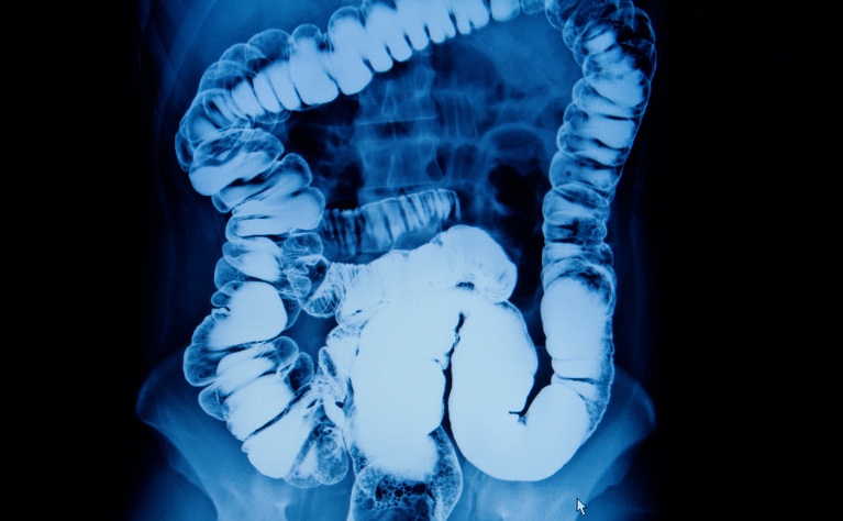 A barium enema x-ray of the large intestine