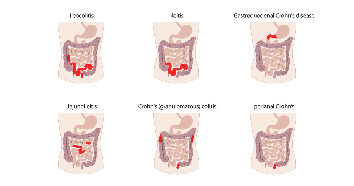 crohn's-disease-types