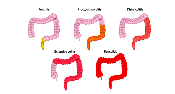 What Is Indeterminate Colitis IBD Relief   Types Of Uc C560x300 